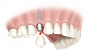 Dental implants near Laguna Niguel, CA