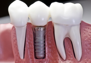 Dental Implant Restoration, Aliso Viejo, CA