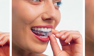 invisalign-tray-in-mouth