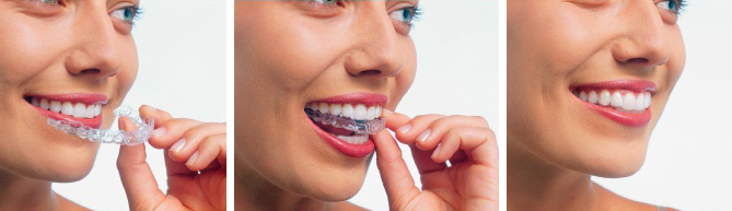 invisalign-tray-in-mouth