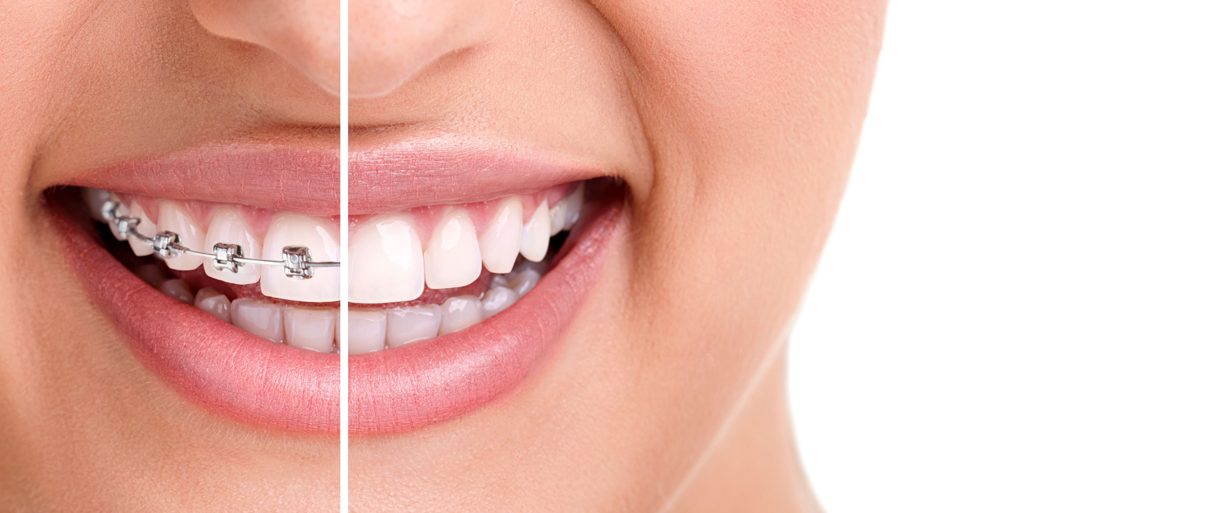 Should You Choose Ceramic Braces or Invisalign? Local Orthodontic Treatment