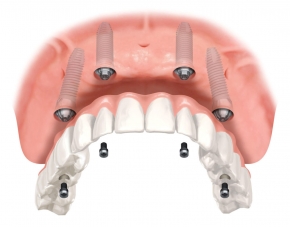 All-on-4, permenant teeth, dentures