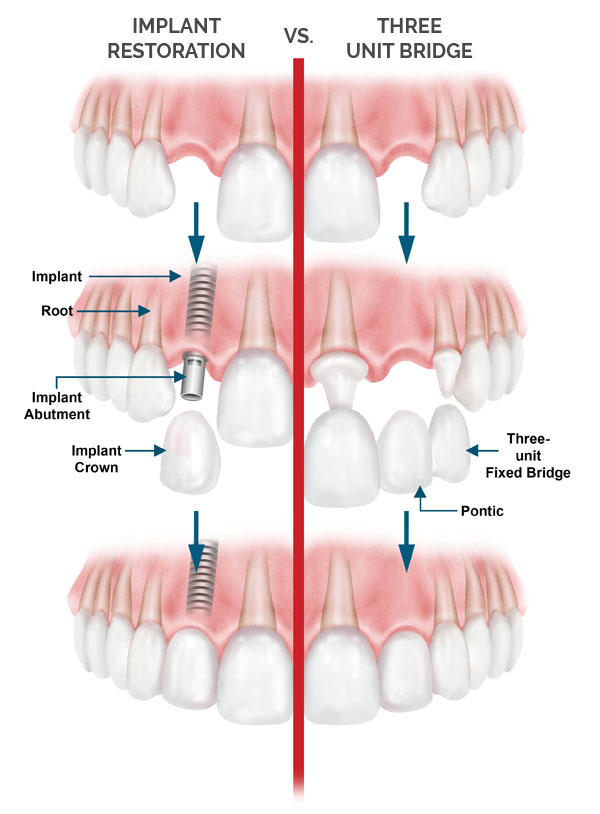 Implant Restorations Aliso Viejo - Bridges California