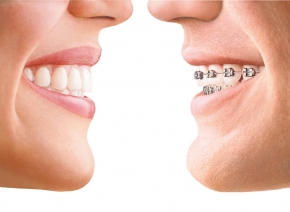 invisalign California - invisalign Aliso Viejo