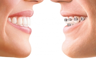 Invisalign Comparison