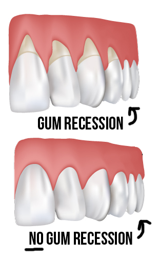 prescription toothpaste for receding gums