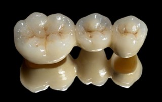 Dental crowns