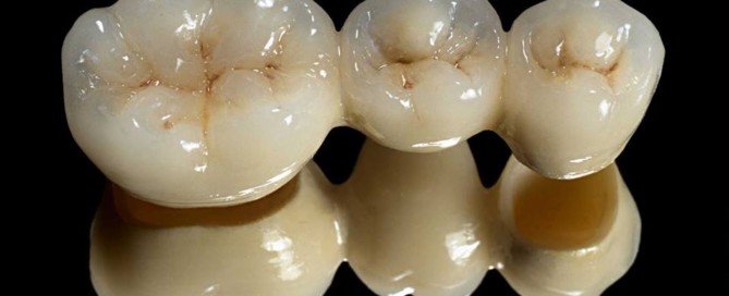 Dental crowns