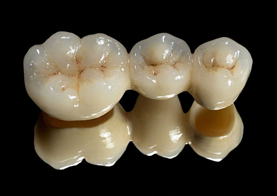 Dental Crowns- They’re not just for royalty.