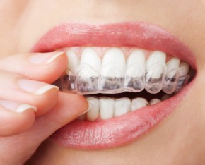 invisalign Aliso Viejo - invisalign Laguna Niguel