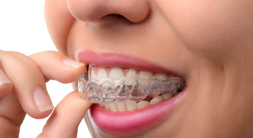 Invisalign for Teens and Adults