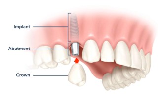 dental-implant-turnerdentalcare