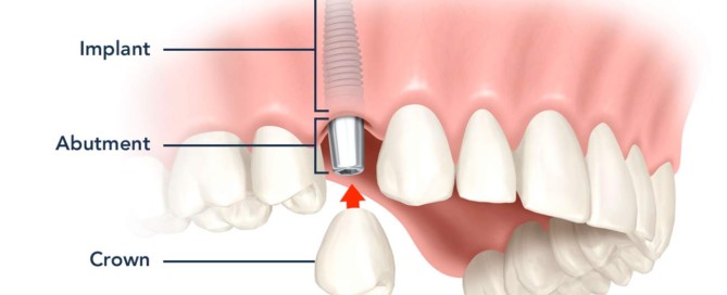 dental-implant-turnerdentalcare