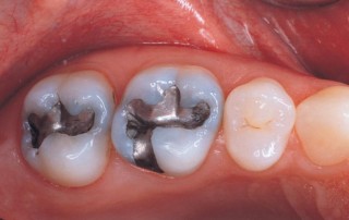 Amalgam Tooth Fillings