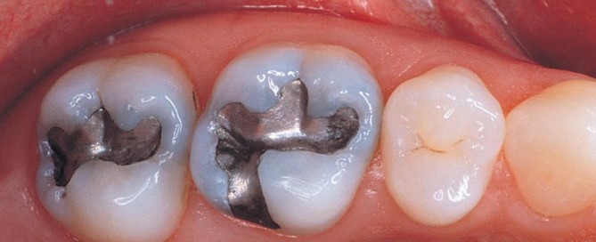 Amalgam Tooth Fillings