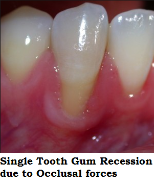 Single Tooth Gum Recession