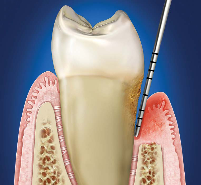 Healthy Gums And Teeth Cleaning Aliso Viejo Dentist Cosmetic Dentist