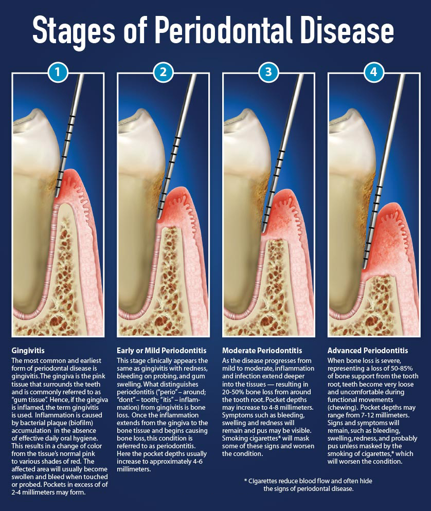 Stages of Periodontal Disease