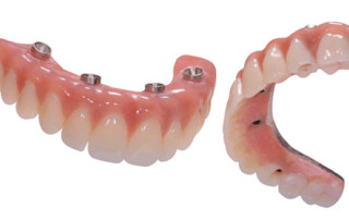 All-on-4 teeth, permenant teeth, dental implants