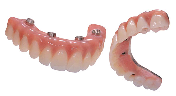 All-on-4 teeth, permenant teeth, dental implants