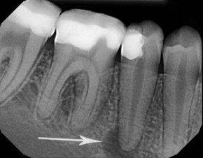 Dental X-rays