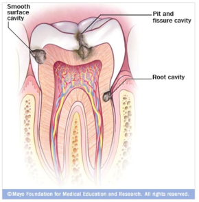 dental decay (cavities)