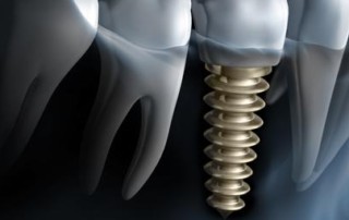 3D graphic of dental implant