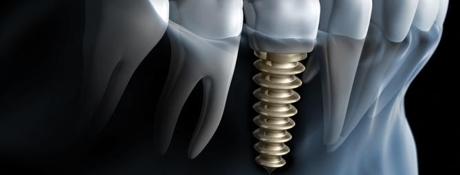 3D graphic of dental implant