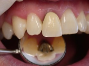 teeth smile crown zirconium