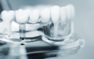 tooth replacement with dental implants