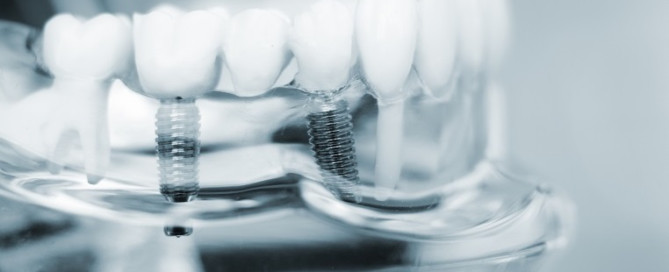 tooth replacement with dental implants