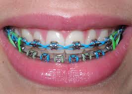 Traditional Braces