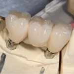 Dental implant bridge, All-on-4, cosmetic dentist