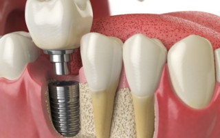 consider dental implants