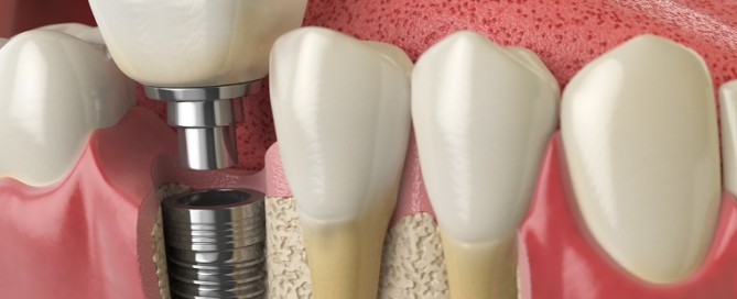 consider dental implants