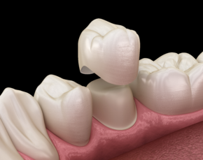 dental crowns; dentist in Aliso Viejo