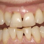 bone loss and gum disease