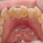 straight teeth vs crooked teeth