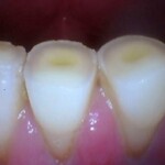 tooth and gums