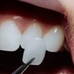 Dental Veneers