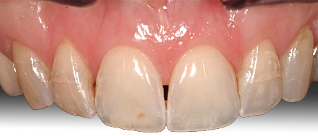 Black triangle of space between teeth