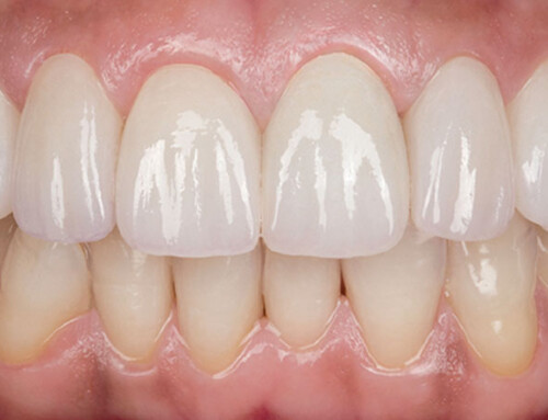 Advantages of Zirconia for Dental Crowns